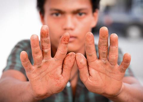 One of the trafficking victims shows the physical damage done to his hands while working aboard a Thai fishing boat © EJF